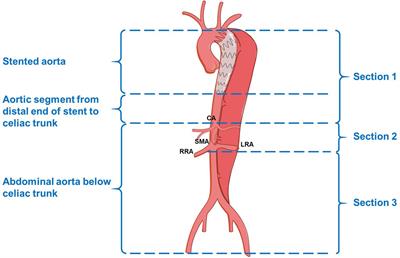 Long-Term Aortic Remodeling After Thoracic Endovascular Aortic Repair of Acute, Subacute, and Chronic Type B Dissections